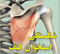 شکستگی استخوان کتف در ناحیه شانه